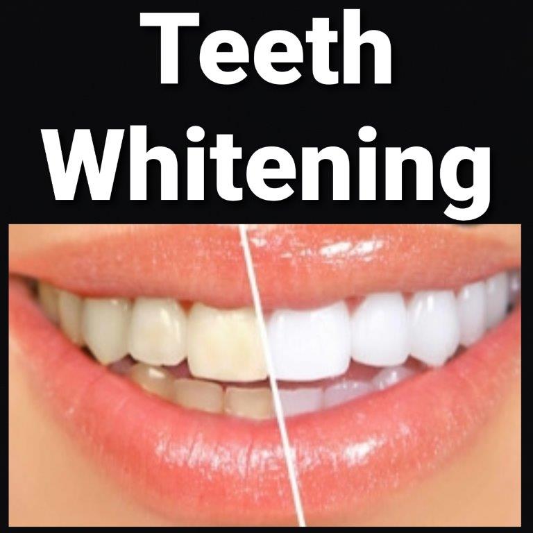 teeth whitening